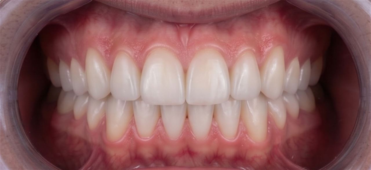 Example anterior bite photo